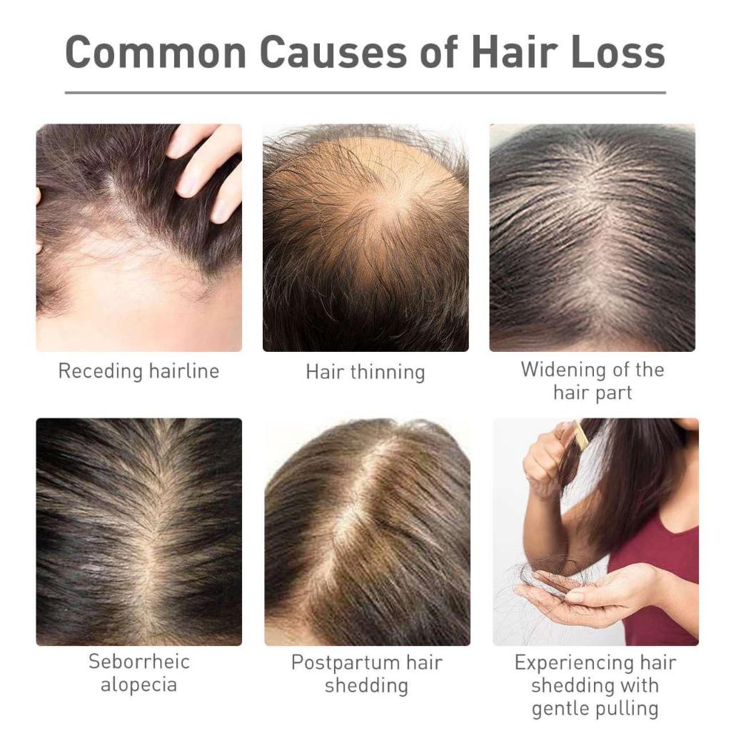 Wiss Herbal Scalp Care Essence Anti-Hairloss Hair Loss Hair Tonic/ Hair Thinning Solution 100ml SG Ready Stock